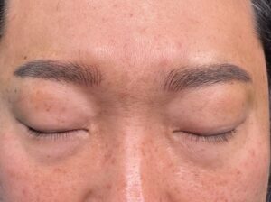 202605-수원남자눈썹-눈썹길이 짧음(시술 후)