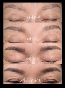 기존 눈썹의 위치와 잔흔을 고려해 새로운 디자인을 설계하고, 필요한 부분만 제거한 후 단계적으로 색감과 밀도를 보완한 눈썹재시술 과정입니다.