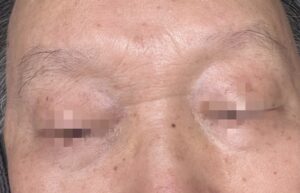 영통남자눈썹 시술전 중년남성의 흐리고 비어 잇는 눈썹상태